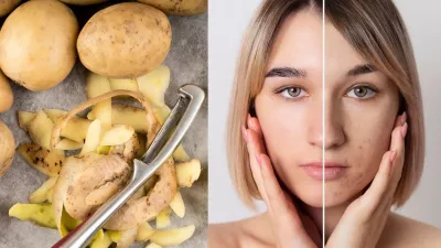 कच्चे आलू के अद्भुत गुण: झाई-झुर्रियों के लिए प्राकृतिक उपचार | Amazing properties of raw potato: Natural remedy for freckles and wrinkles