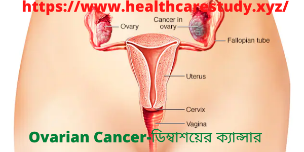 Ovarian Cancer-ডিম্বাশয়ের ক্যান্সার