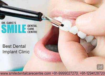 Best Dental Implant Clinic in Faridabad