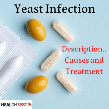 Yeast Infection: Depiction, Causes and Treatment