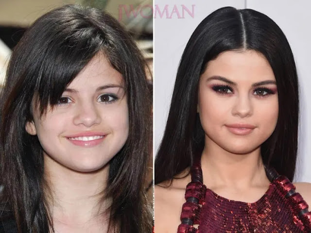 Selena Gomez Before And After The Plastic Surgery.
