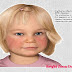 Fifth Disease or Slapped Cheek Syndrome – Diagnosis and Treatment.