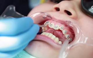 Niềng răng có ảnh hưởng gì không? Tìm hiểu ngay-1