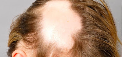 Androgenetic Alopecia Treatment Market
