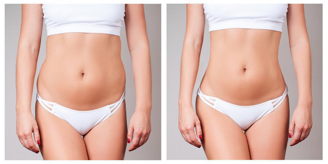 Sculpt Your Body to Perfection with Body Contouring Procedures