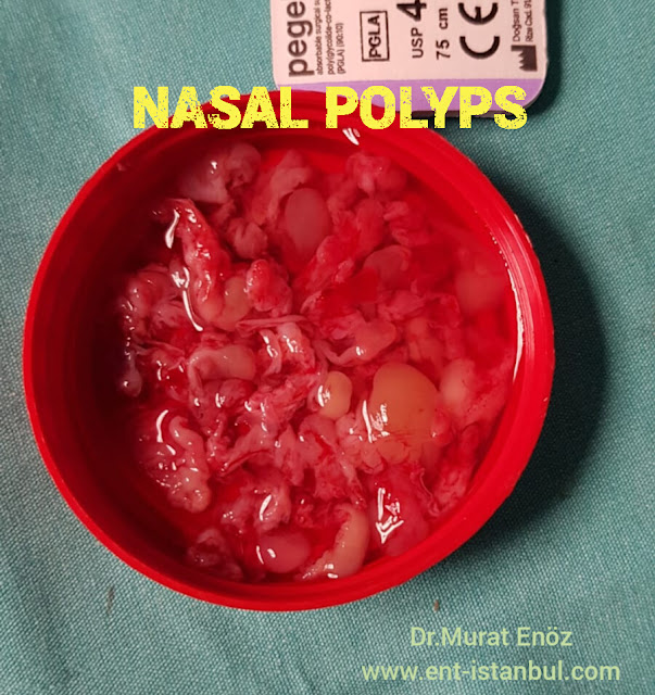 Nasal Polyps