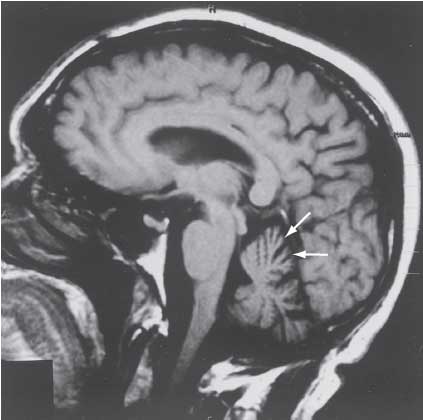 Sagittal MRI of the brain