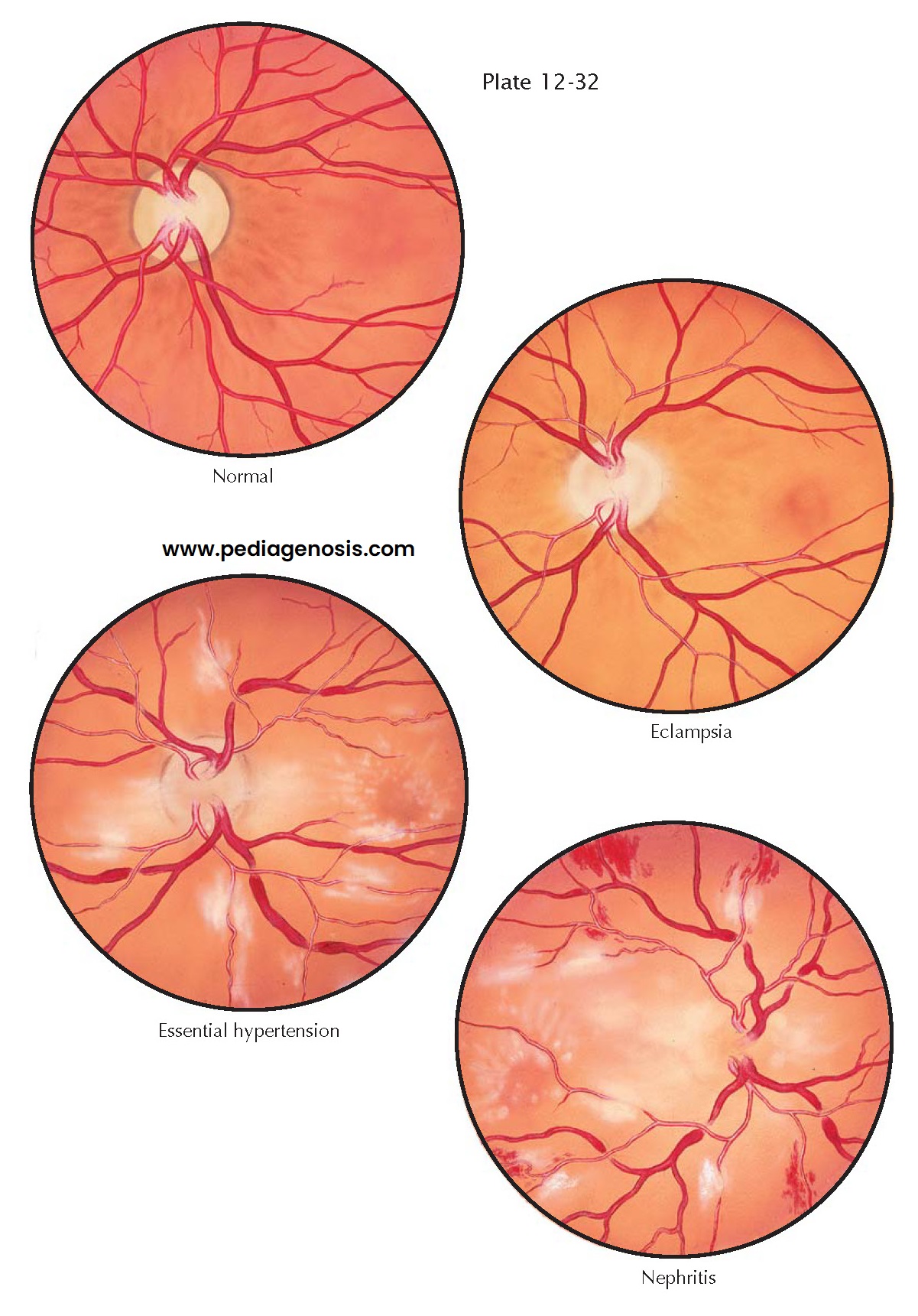 PREECLAMPSIA II— OPHTHALMOLOGIC CHANGES IN PREECLAMPSIA AND ECLAMPSIA