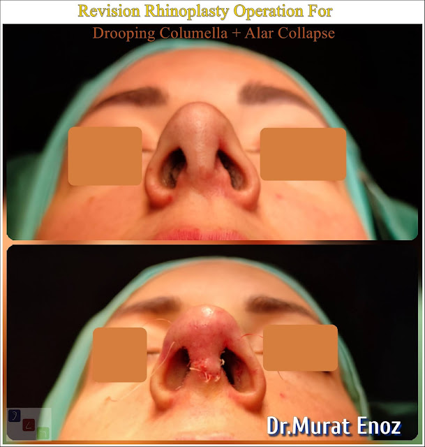 Drooping Columella,Hanging Columella,Revision rhinoplasty in women,Secondary nose job,Alar Collapse After Nose Aesthetic Surgery,