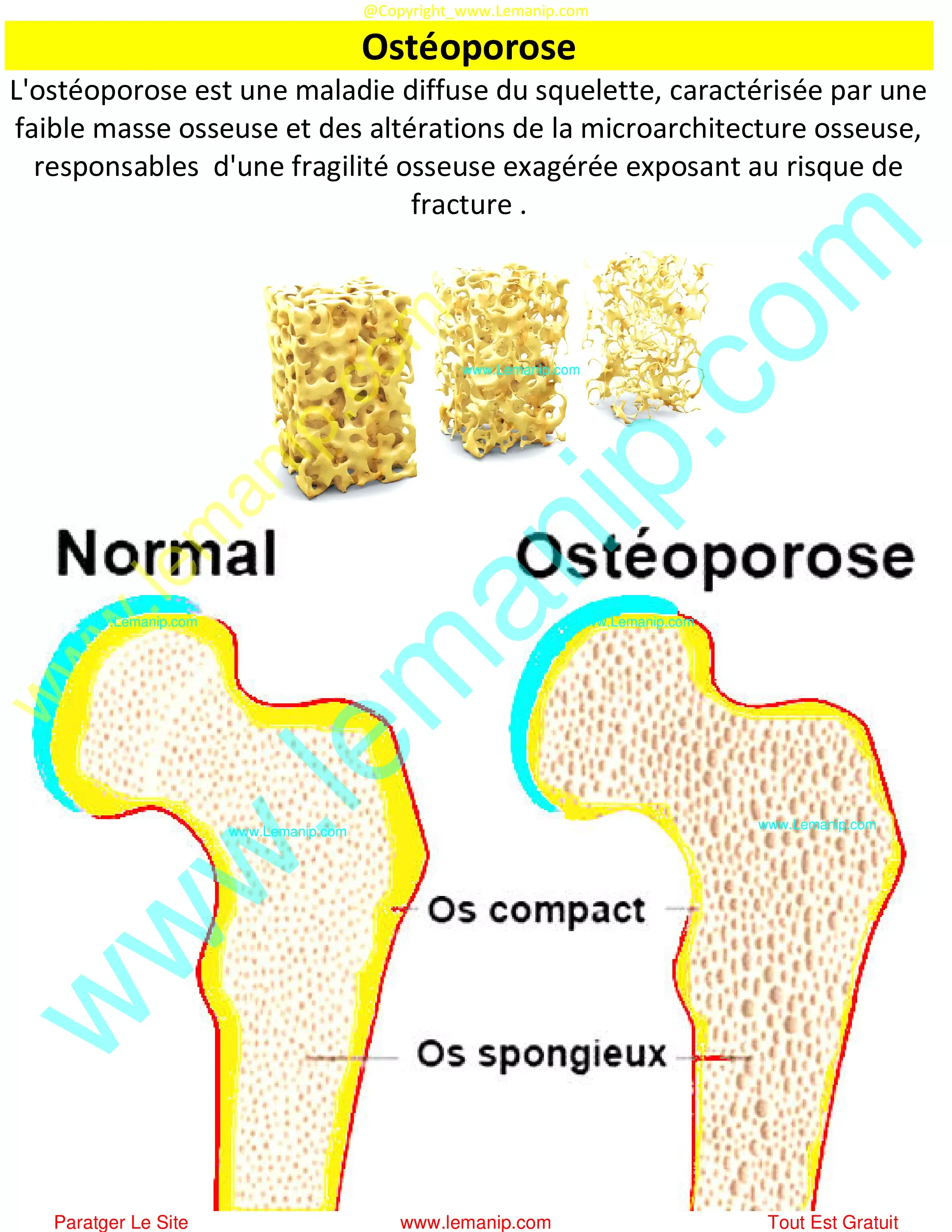 Ostéoporose