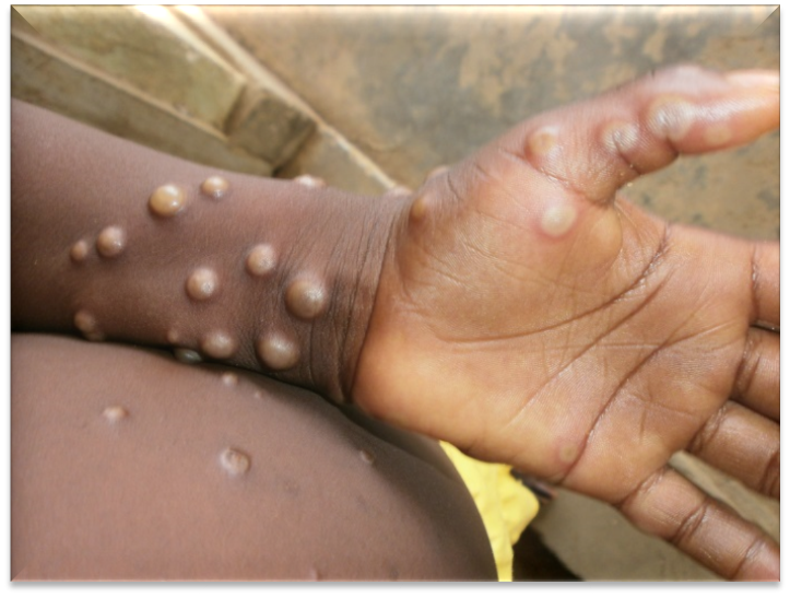 Monkeypox: Symptoms, Treatments And Prevention.