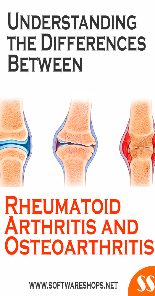 Differences Between Rheumatoid Arthritis and Osteoarthritis