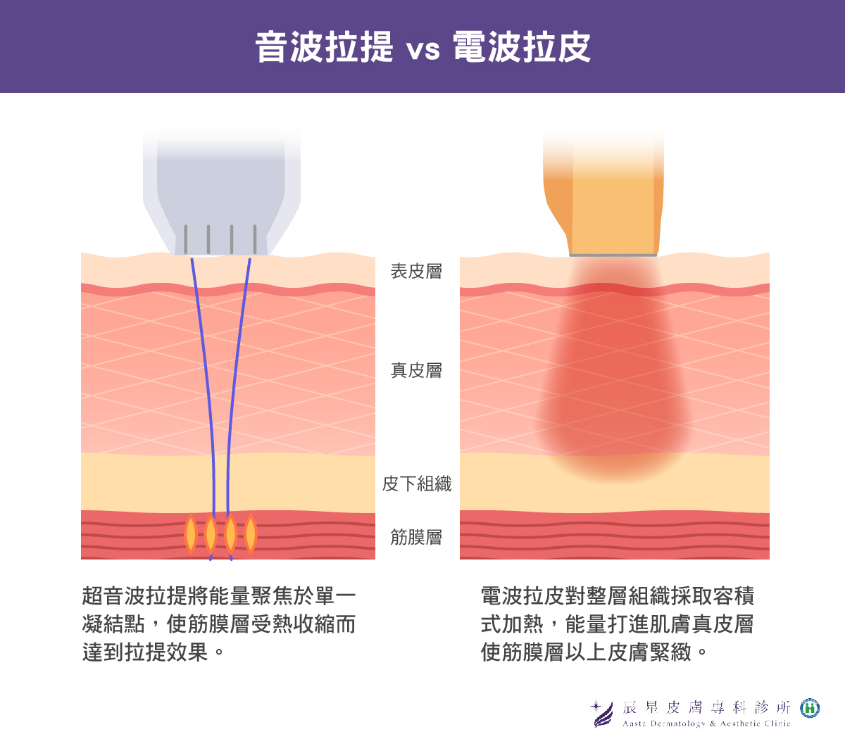 音波拉提電波拉提介紹