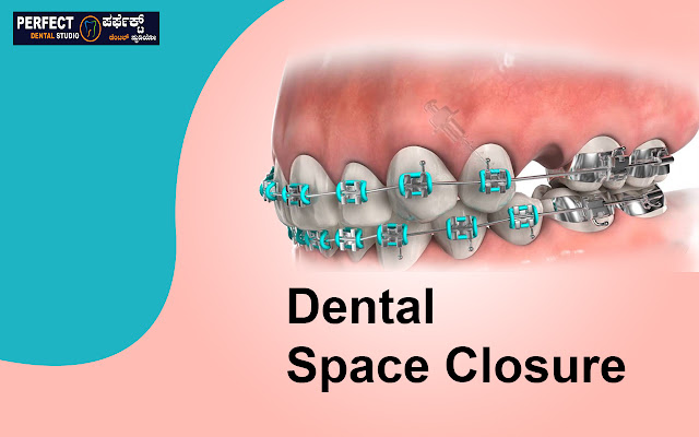 dental space closure in Kodichikenahalli