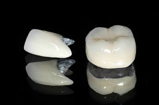 Quy trình làm cầu răng sứ-1