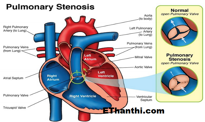இதயத்தில் பல்மனரி வால்வு அடைப்பு ஏற்பட்டால் என்னவாகும்?