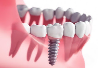 Cấy răng implant bao nhiêu tiền-2