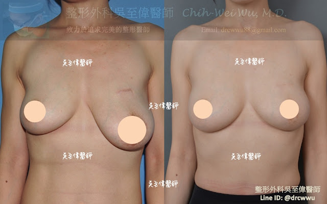 ▲單側乳房下垂，接受垂直切口棒棒糖提乳，術後五年