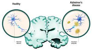 alzheimer-disease