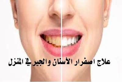 علاج اصفرار الأسنان والجير -  العلاجات الطبيعية لازالة اصفرار الاسنان في المنزل