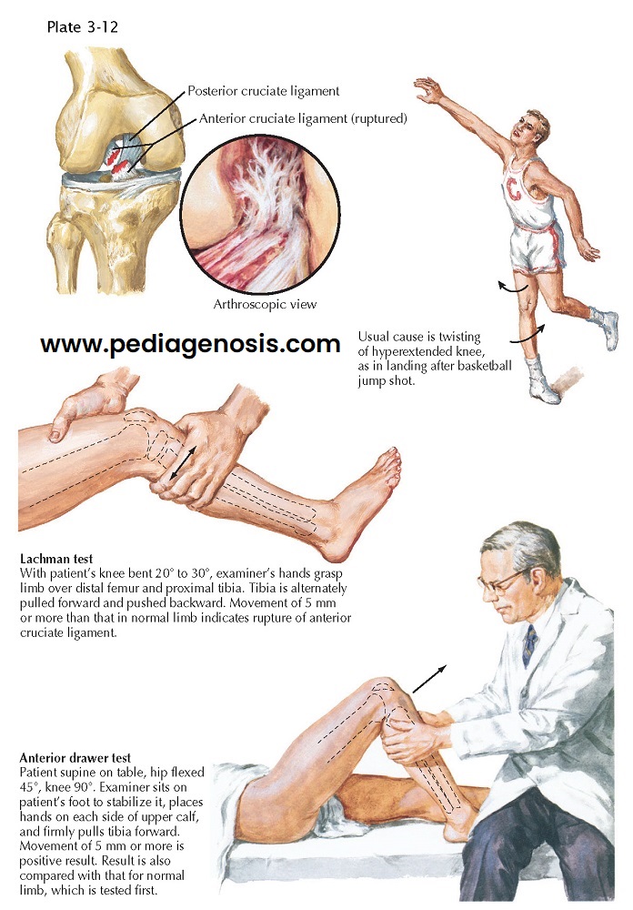 RUPTURE OF THE ANTERIOR CRUCIATE LIGAMENT