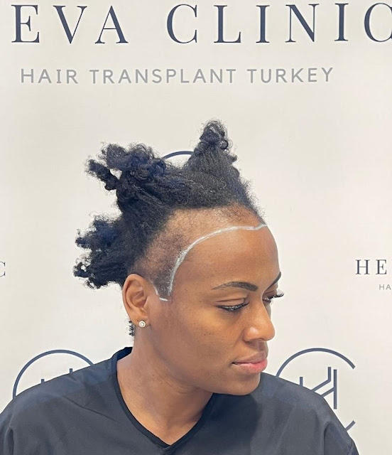 Heva Clinic: Afro-Hair Transplant Specialization in Turkey