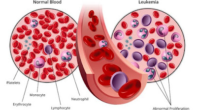 Pengertian Tentang Penyakit Kanker Darah