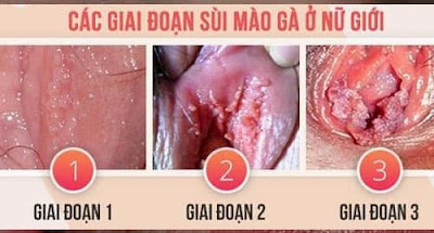 Hình ảnh sùi mào gà ở nữ qua các giai đoạn