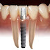 Cấy ghép răng implant tại nha khoa