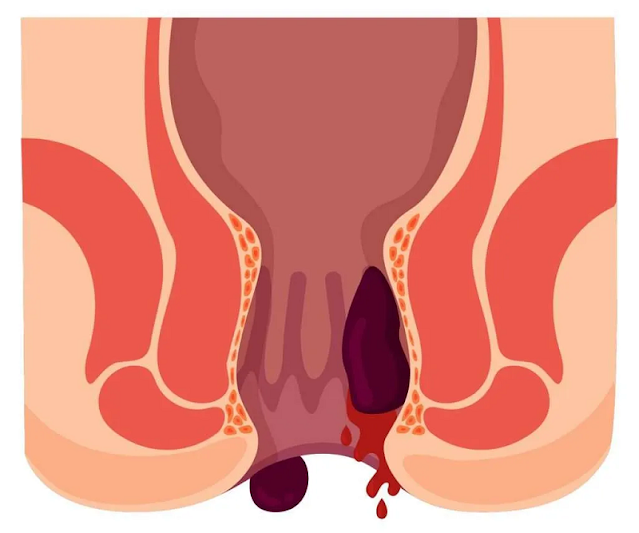 Hemorrhoid Treatment: Comprehensive Solutions for Lasting Relief