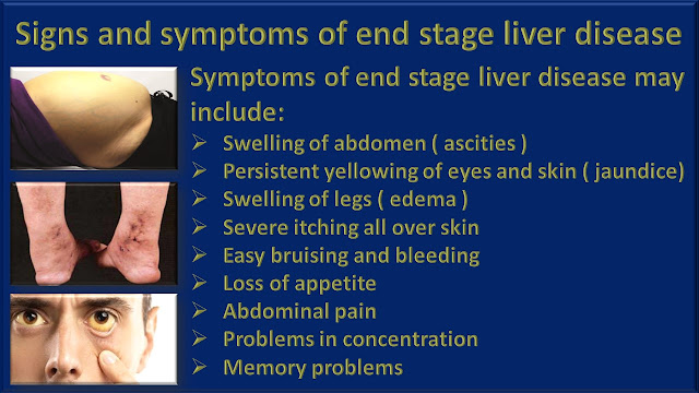 Signs and symptoms of end stage liver disease or chronic liver failure.