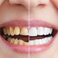 Teeth whitening in Delhi