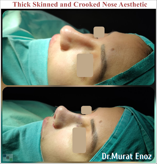 Crooked Nose Aesthetic Surgery in Istanbul,Twisted Nose Rhinoplasty,