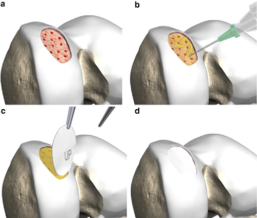 Autologous Matrix-induced Chondrogenesis