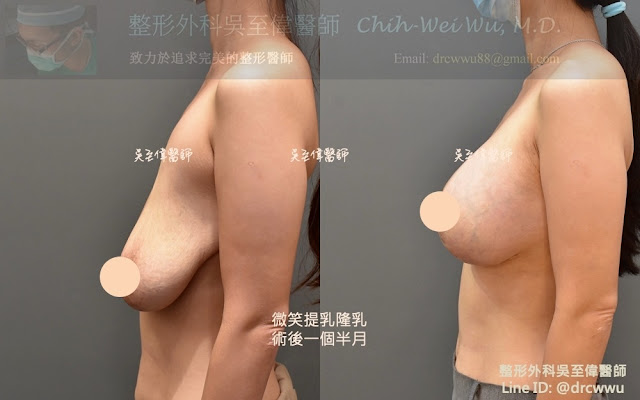 垂直棒棒糖切口提乳合併假體隆乳