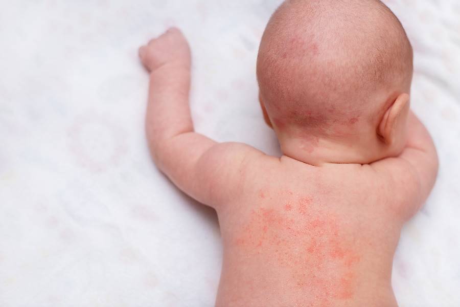 Bebe con dermatitis