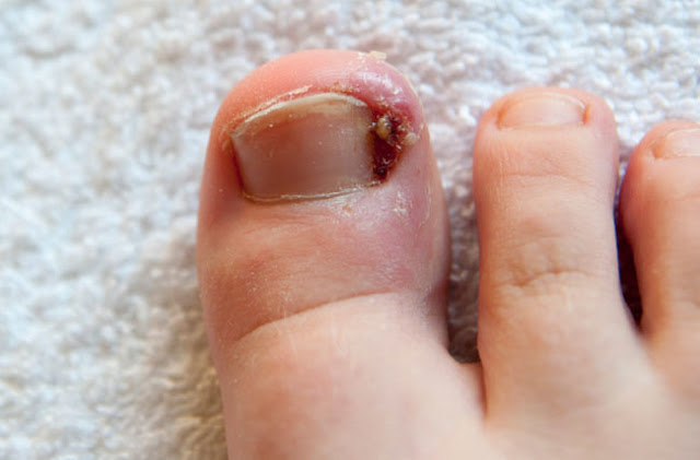 Ingrown Toenails