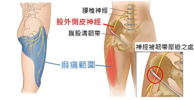 #大腿外側麻 #大腿外側痛 #麻痛性股痛 #感覺異常性股痛 #Meralgia Paresthetica