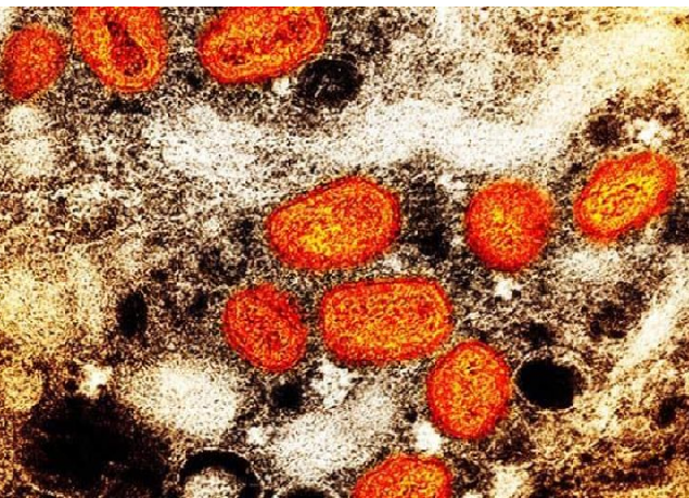México: Registran 60 casos de viruela símica en el país en los últimos 14 días