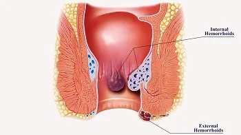 Hemoroid Nasıl Geçer