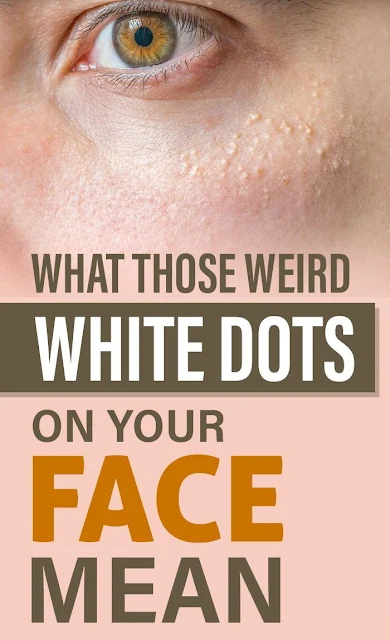 This Is What Those Weird Small White Dots On Your Face Mean!