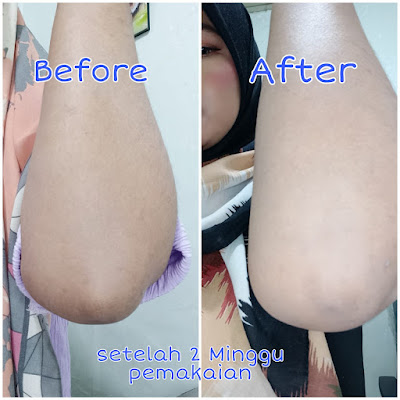 before after everwhite axillary cream