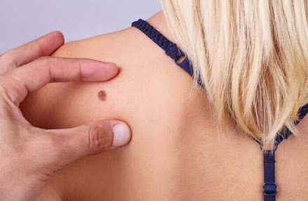  Razões pelas quais as pintas podem se transformar em câncer de pele tipo melanoma