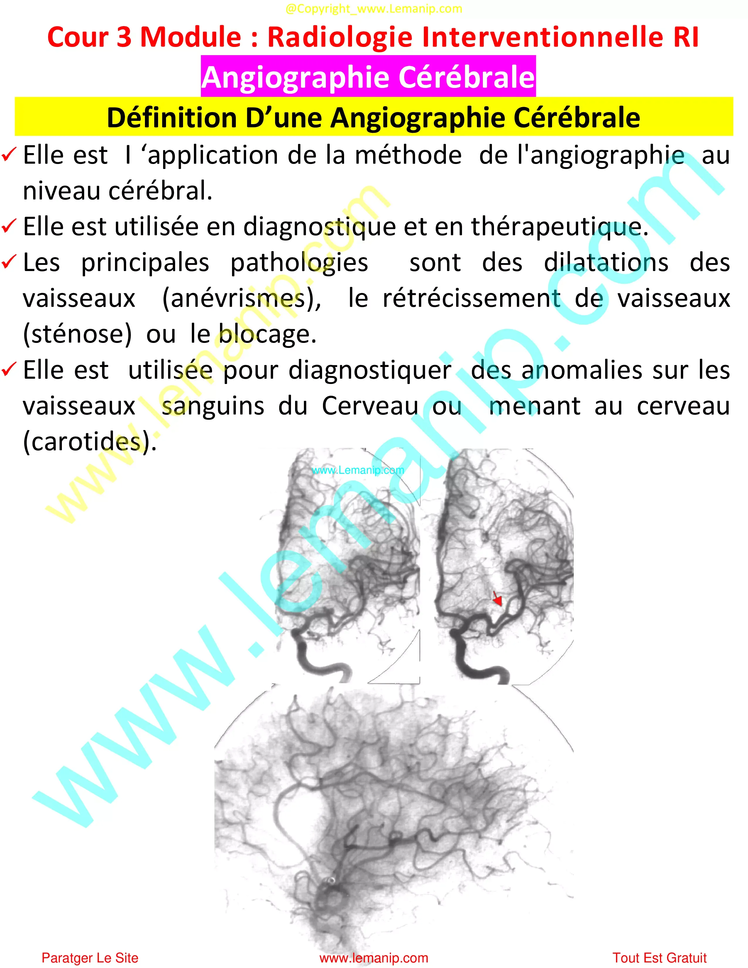 Définition D’une Angiographie Cérébrale