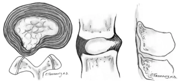 Na avaliação de um paciente com dor na coluna, a ressonância mostra uma alteração discal que está representada na figura abaixo.