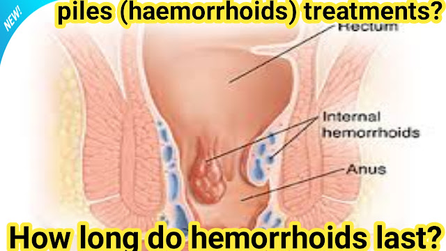 Food for piles,Bleeding piles treatment ,Symptoms of piles in female,Hemorrhoid cream,External piles treatment,Piles symptoms pictures,piles (haemorrhoids) treatments,How long do hemorrhoids last,What do piles look like on your bum?What happens if piles is not treated?,How long does piles last?,What is the main cause of piles?