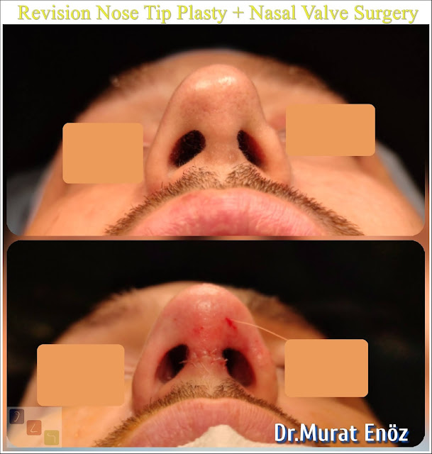 Revision Nose Tip Plasty + Nasal Valve Surgery