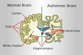 Alzheimer's-disease-a-zheimer's-disease-brain
