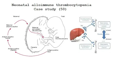 Case study (50) – Neonatal alloimmune thrombocytopenia