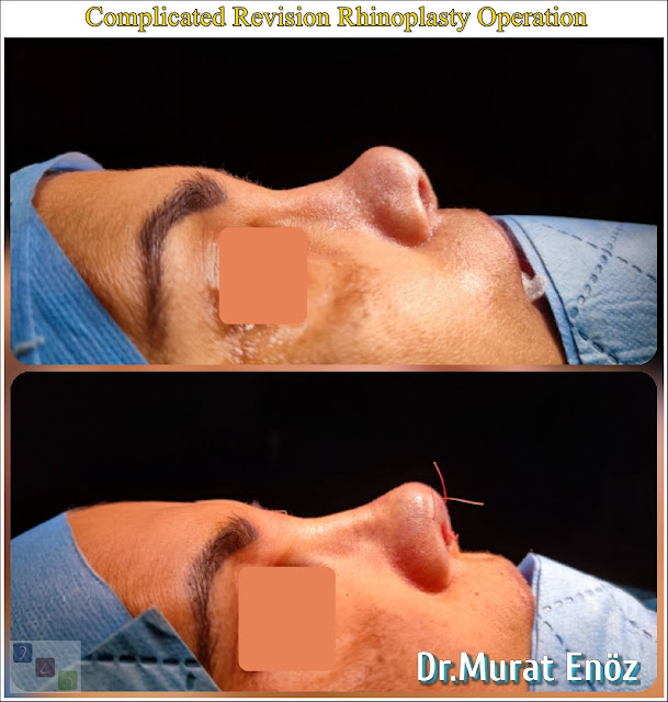 Revision rhinoplasty using rib cartilage,Secondary rhinoplasty,revision nose aesthetic surgery,Revision nose job in Istanbul,